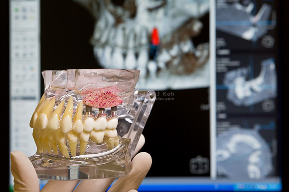 Dental tooth implant, dentistry